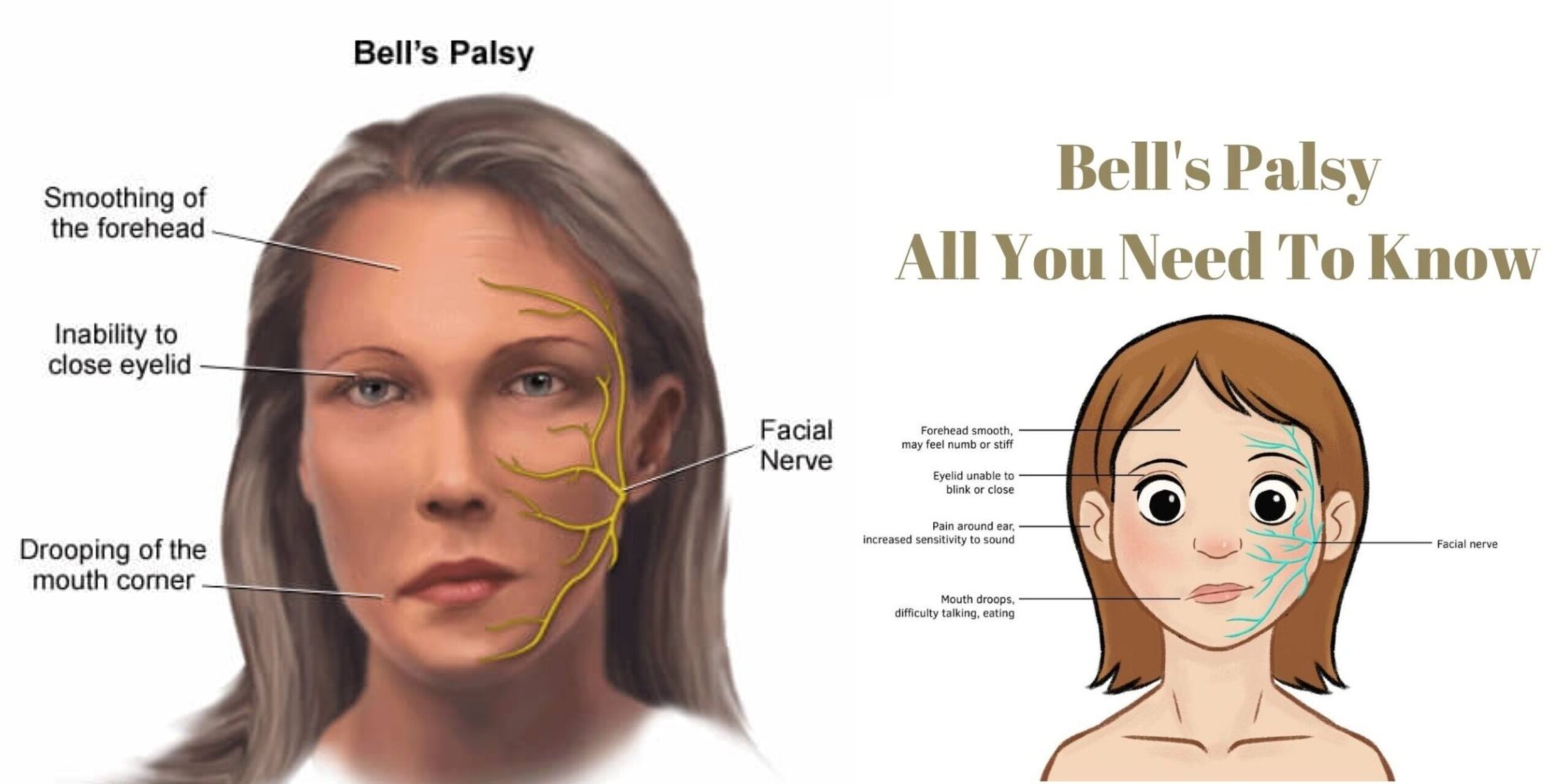bell's-palsy-picture